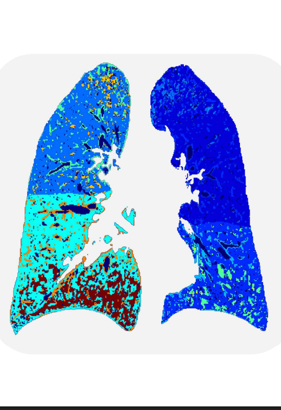 Lungnest